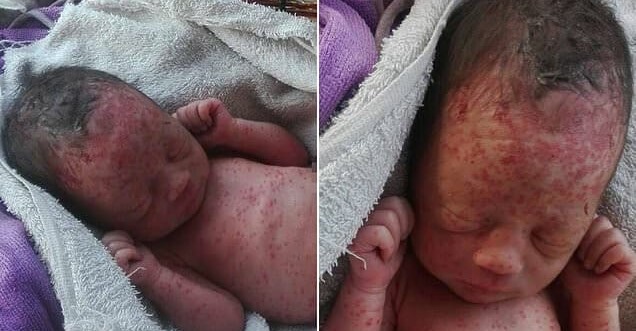 Helpless Newborn Girl Found Abandoned and Covered in Bug Bites