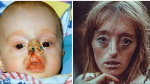 A young girl was born with a rare facial deformity; now, she is defying beauty standards through her modeling career.