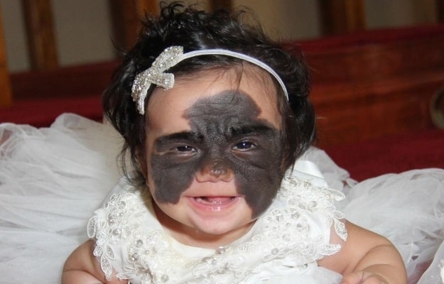 A girl with a ‘Batman Birthmark’ was finally able to have it removed thanks to groundbreaking surgery. Wait until you see how she now looks.