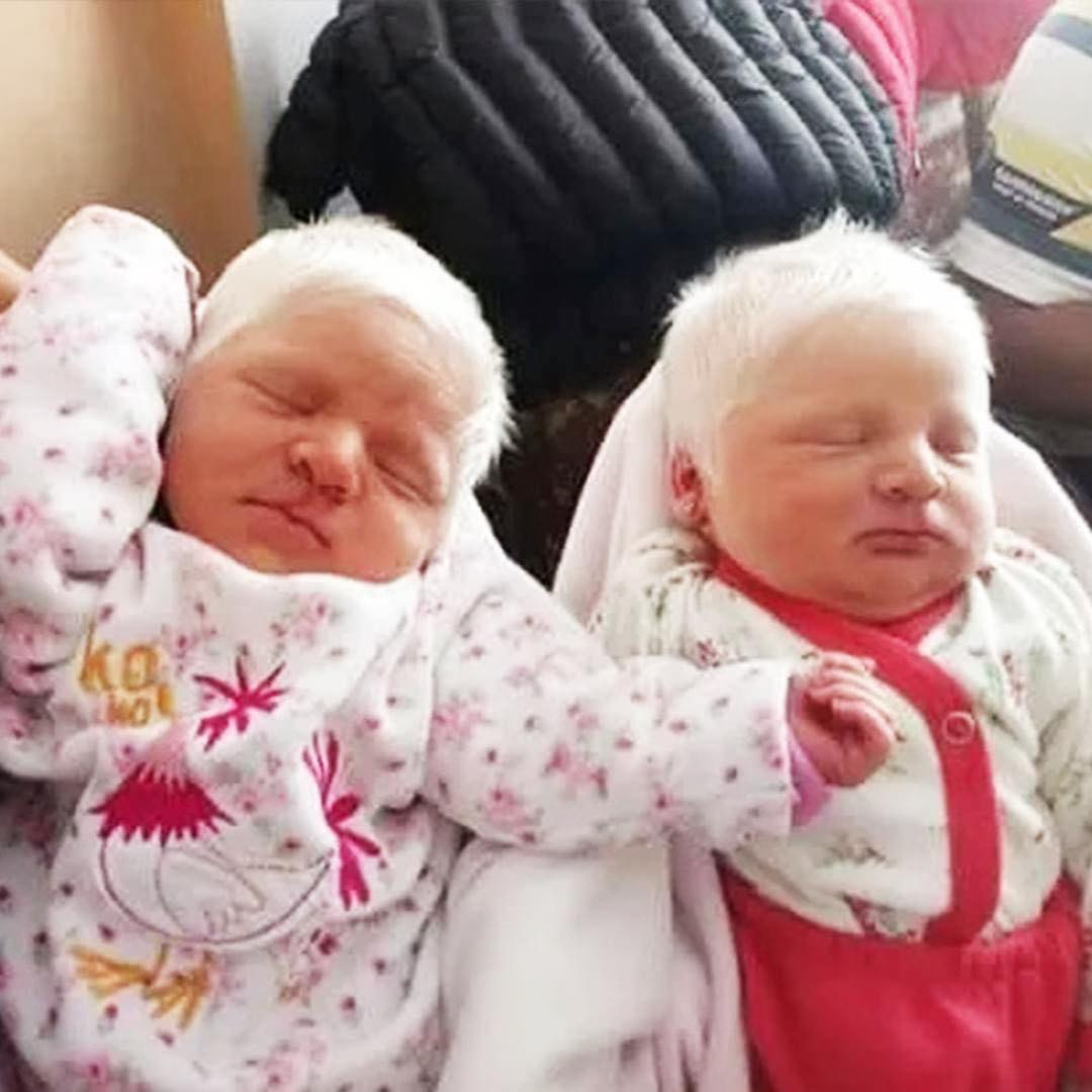 Mom Gives Birth to Rare Albino Twins With Snow-White Hair