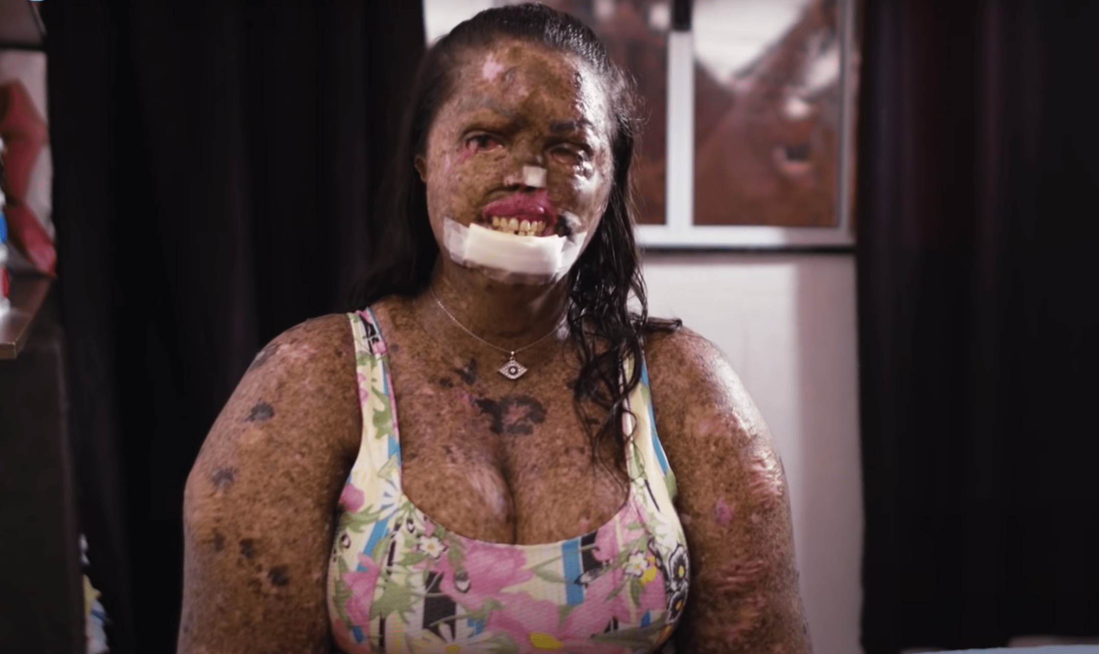 Woman with rare skin condition overcomes negativity and finds true love