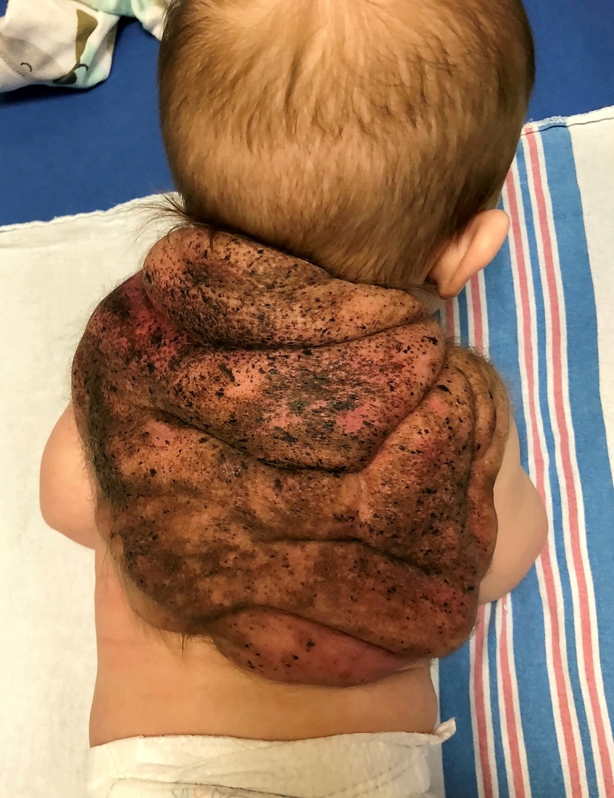 ‘LITTLE NINJA’ – We thought our little boy just had a birthmark – he ended up growing a ‘turtle shell’