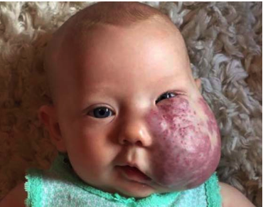 The incredible story of Sloan McGillis: She was born with a giant facial tumor – but overcame all obstacles