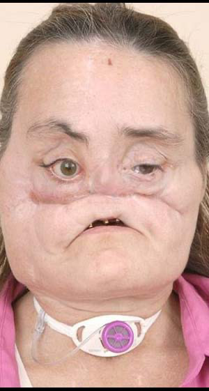 Connie Culp was the first face transplant patient in the United States