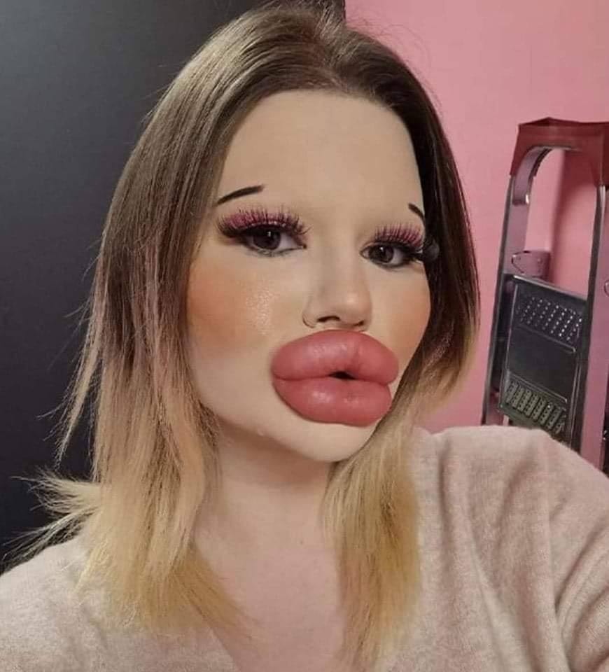 25-Year-Old Bulgarian Woman Does More Than 27 Procedures To Have The Biggest Lips In The World