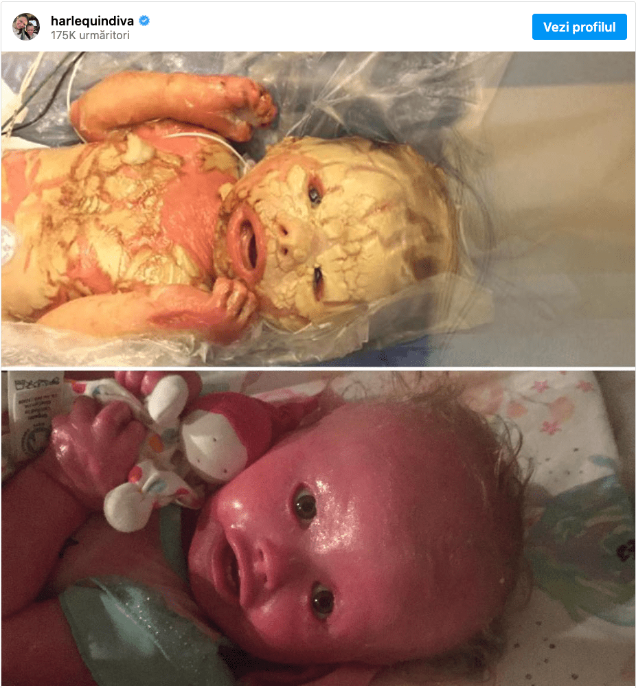 Doctors carry out emergency C-section and deliver a baby with a rare skin condition