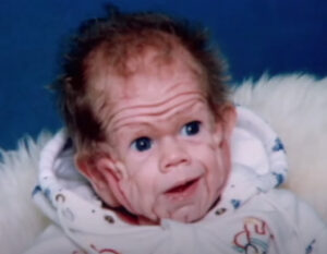 Tomm Tennent: The unique baby born with enough skin for a five-year-old child