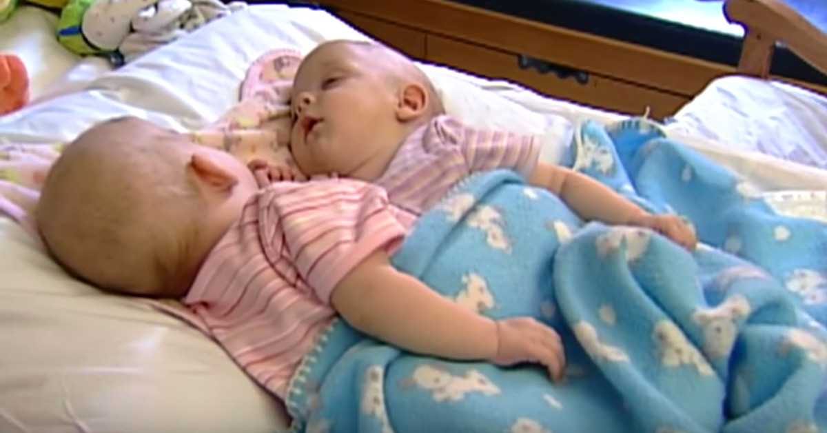 Conjoined twins were connected from birth, but surgery permanently changed everything