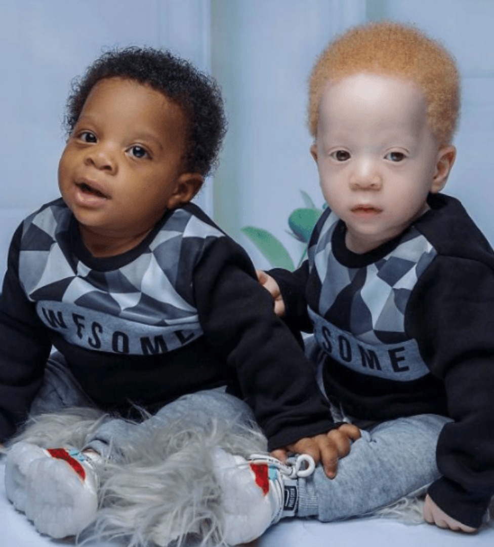 An Extraordinary Journey of Twin Boys with Unique Features