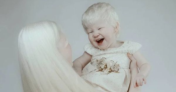 Albino Sisters: A Journey of Beauty and Success