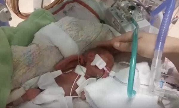 The Inspiring Journey of Baby Tru: Born Weighing Just 1 Pound