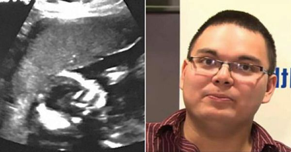 A Miracle Birth: 1 in 15 Million Chance!