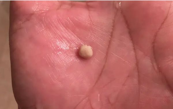 tonsil stones