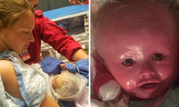 A Miracle Baby Overcomes a Rare Skin Condition