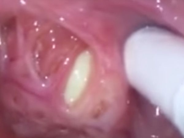 tonsil stones