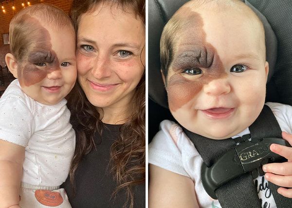 Mom Shares Her Daughter’s Beautiful Birthmark, Gathering 300k Followers Supporting Their Journey