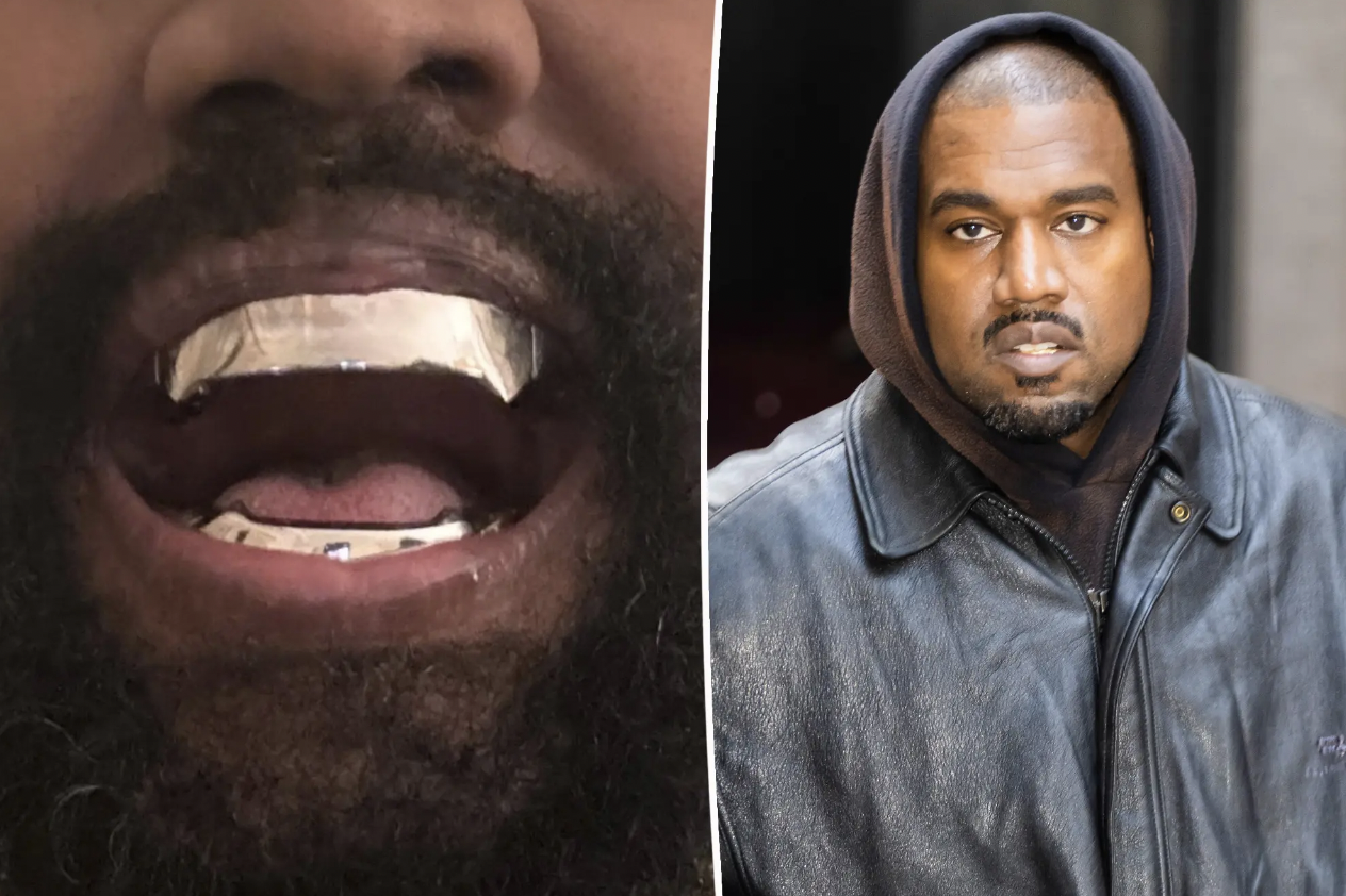 Kanye West’s Experimental Dentistry: Titanium Teeth that Last